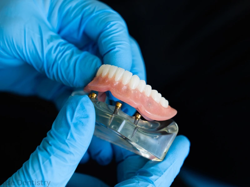 dentures vs implants costs