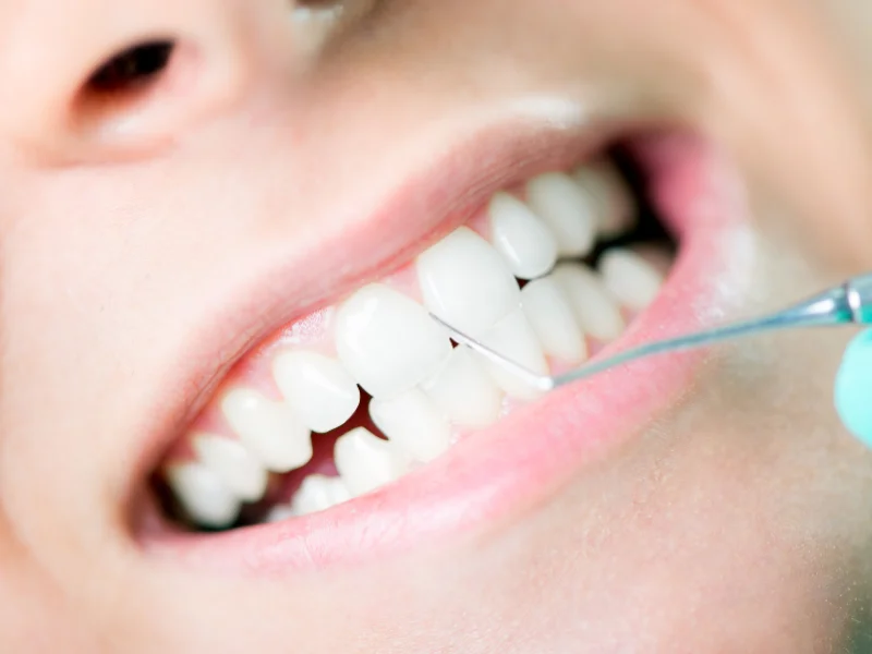 eating after teeth cleaning