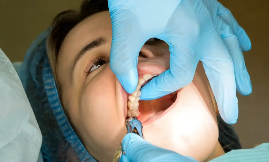 how long does wisdom teeth removal take