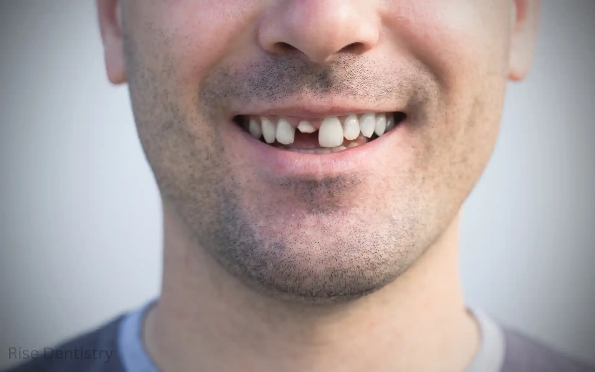 how to fix a broken tooth