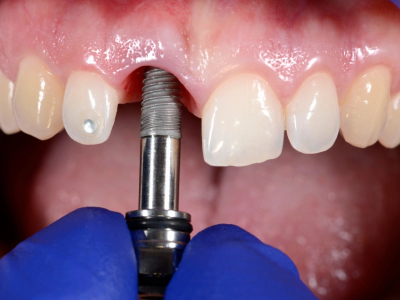 permanent dentures cost