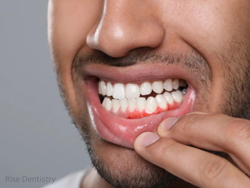 poor oral hygiene
