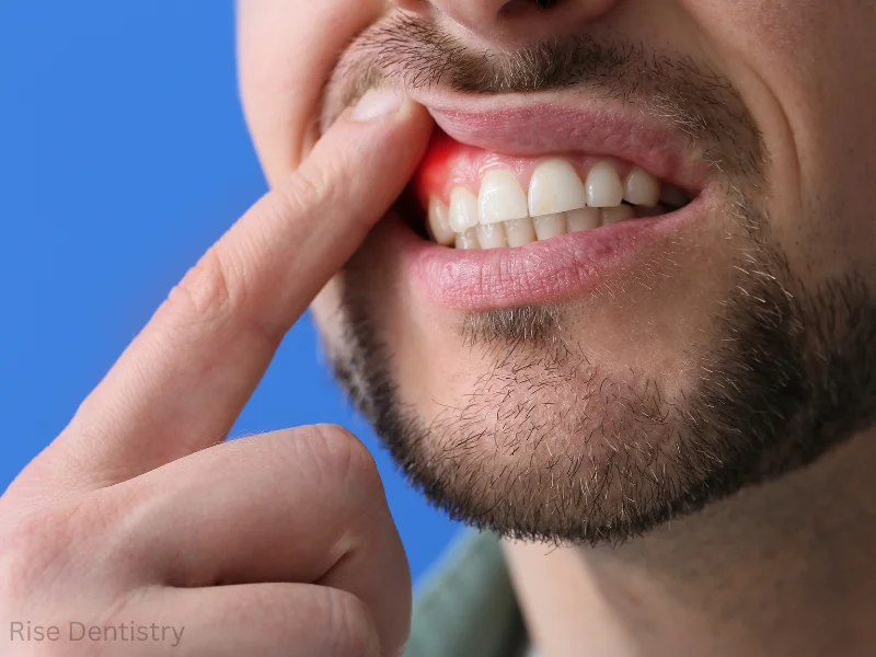swollen gums around one tooth
