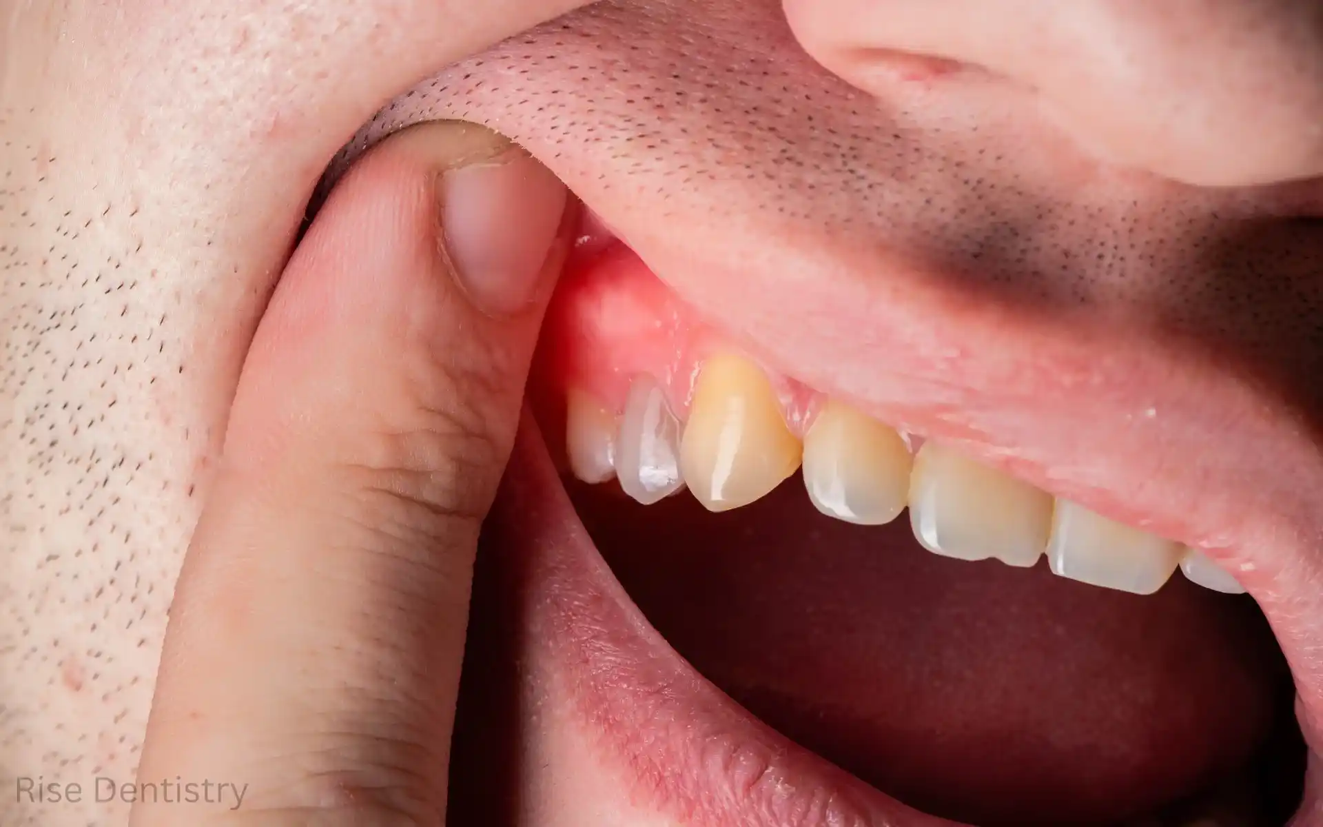 why is my gum swollen around one tooth