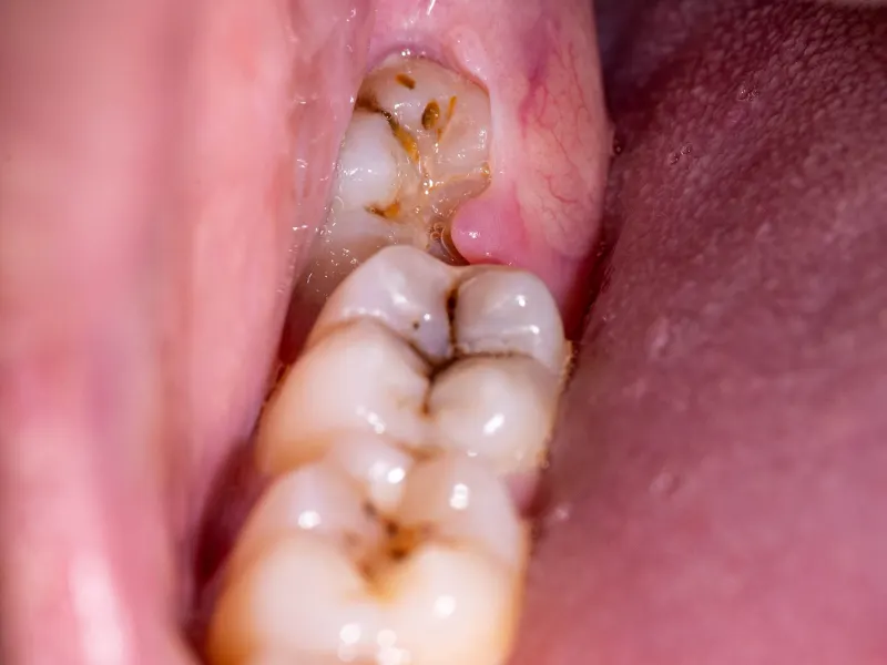 wisdom tooth extraction complications