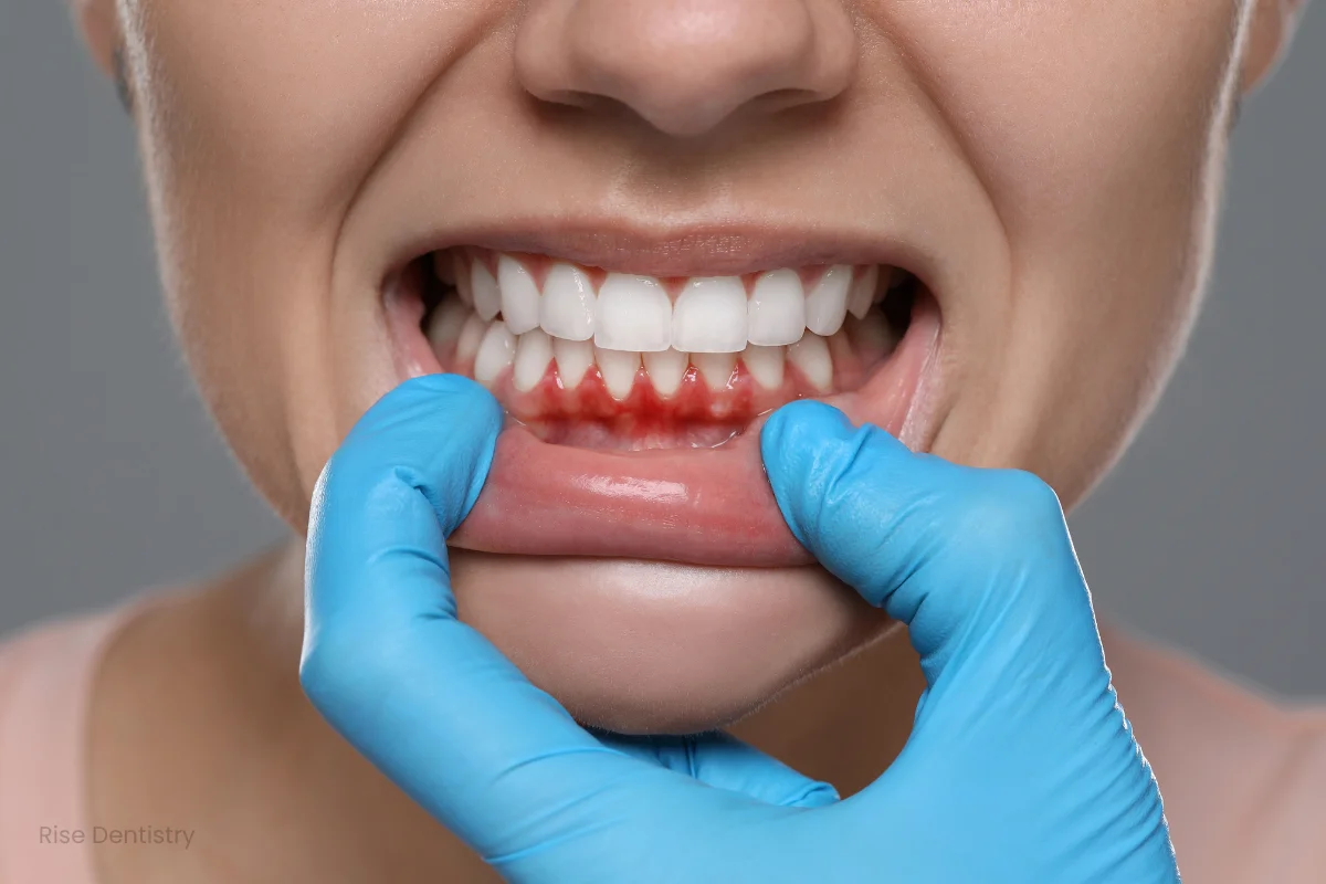 bleeding gums after dental cleaning