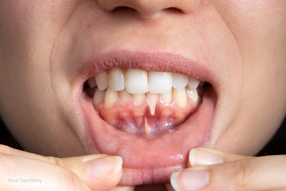 bleeding gums before dental cleaning