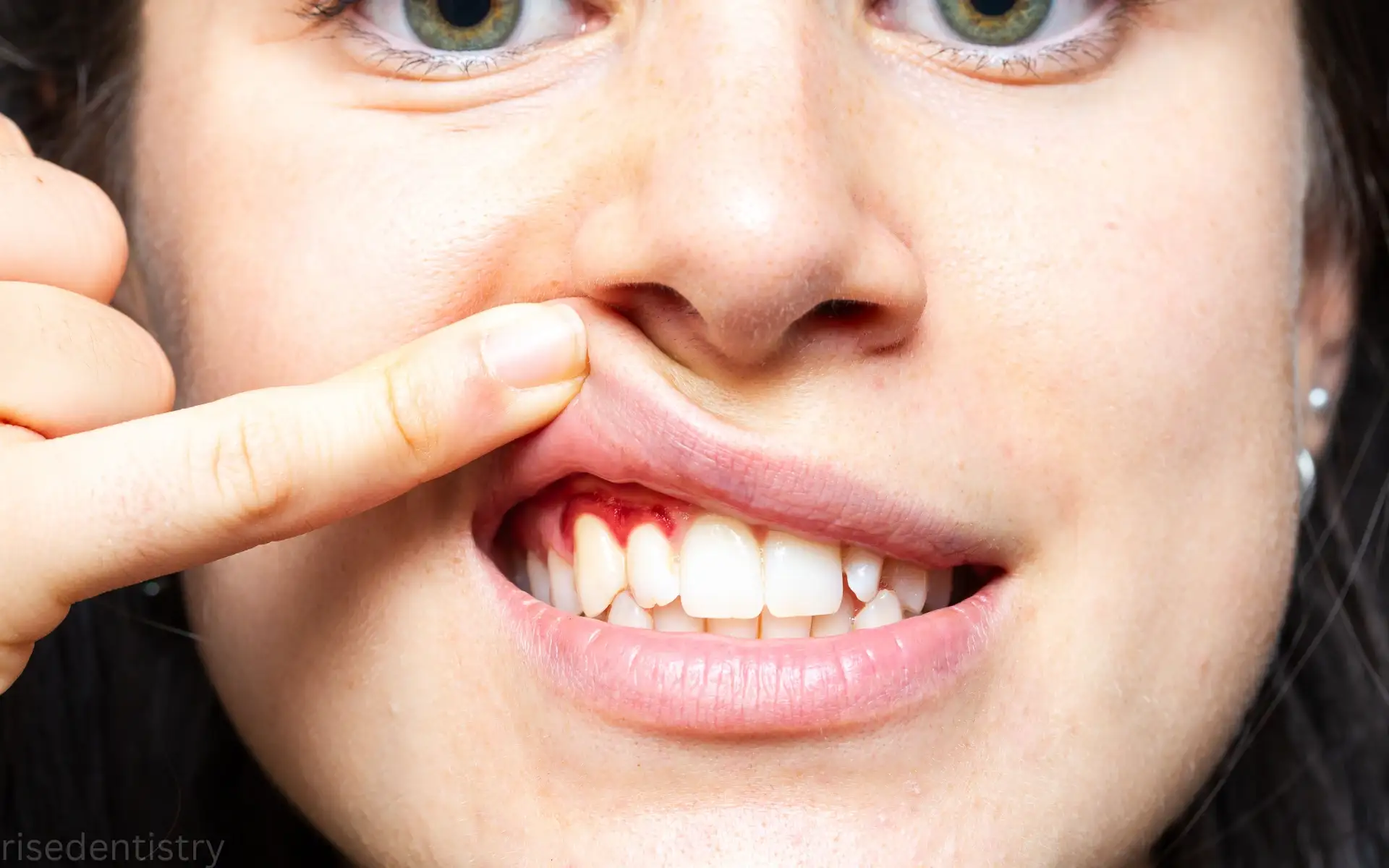 bleeding gums treatment in magnolia tx