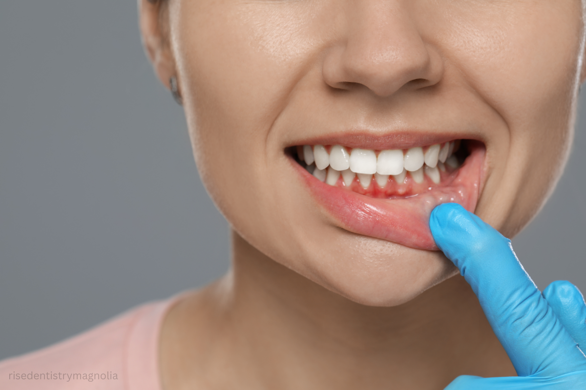 bleeding gums treatment magnolia texas
