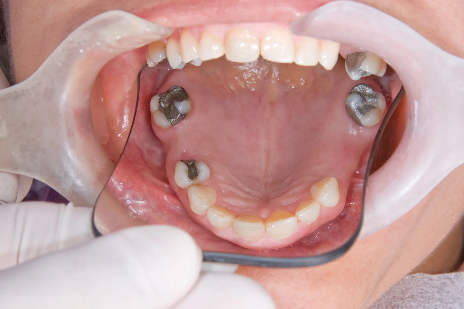 can you get implants after dentures