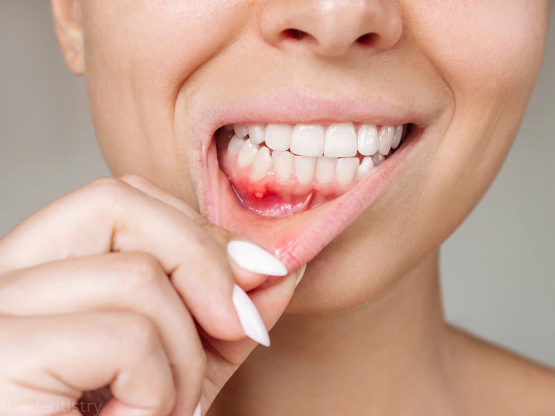 candidate for tooth abscess treatment