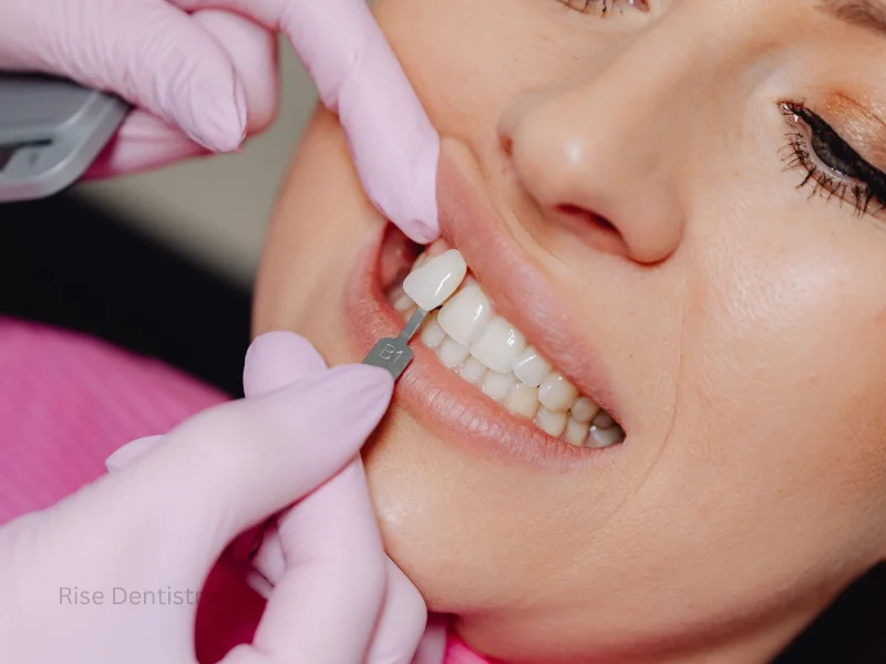 candidates for porcelain veneers