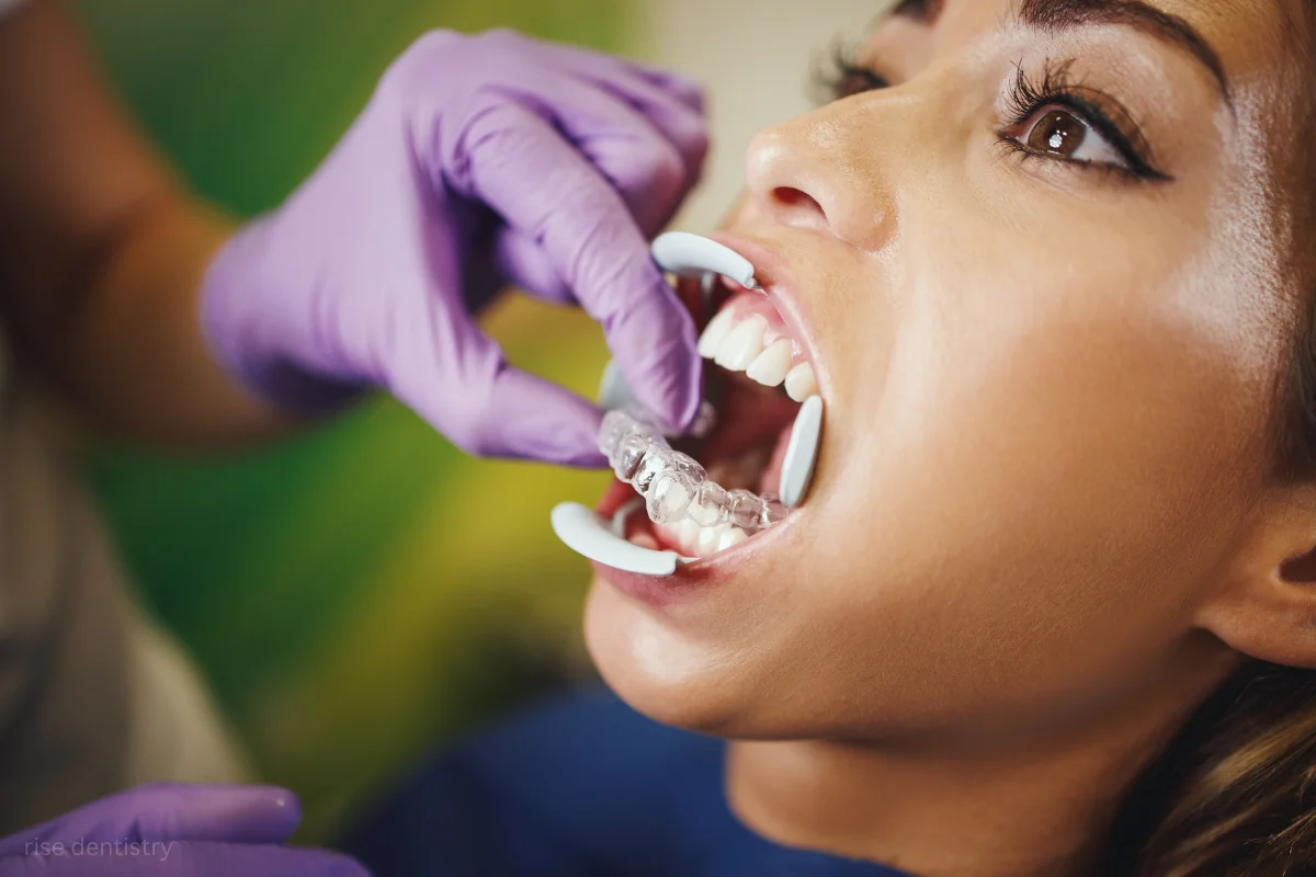 clear aligners right for you
