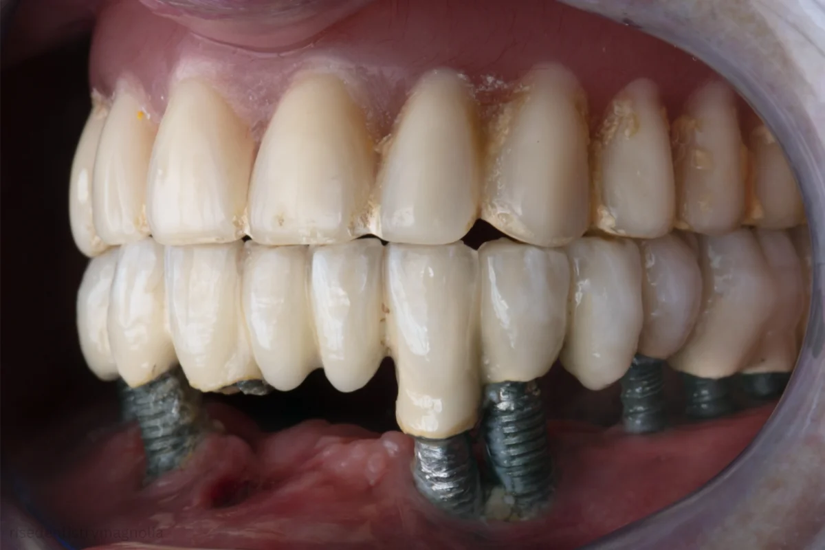 conventional dentures