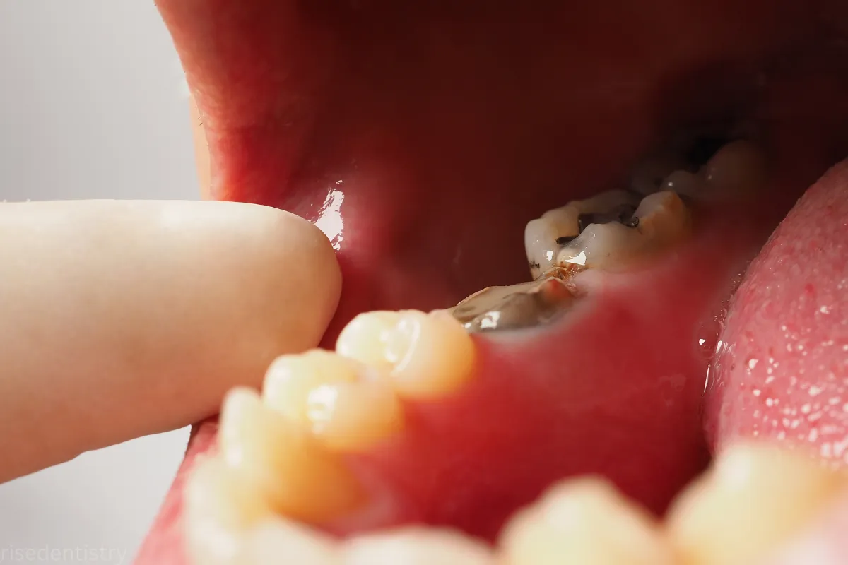dental cavity filling