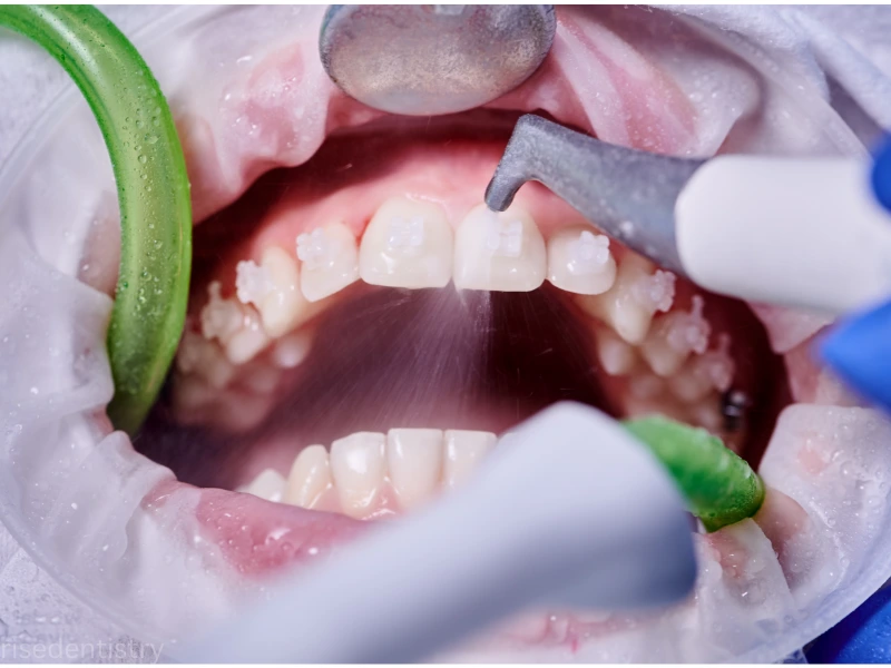 dental deep cleaning recovery