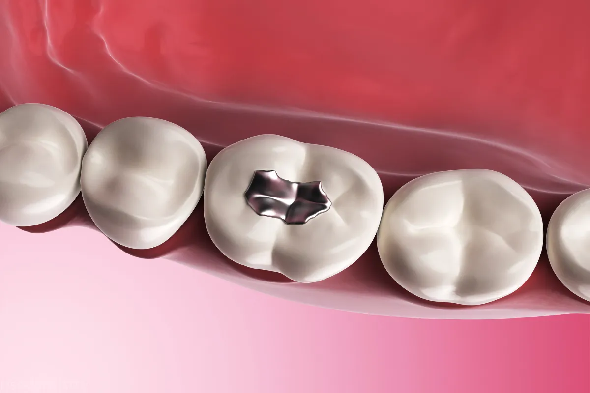 dental filling aftercare