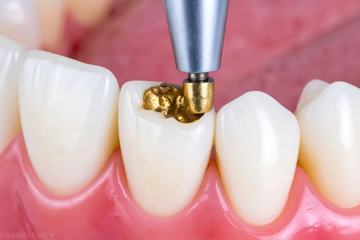 dental filling near me