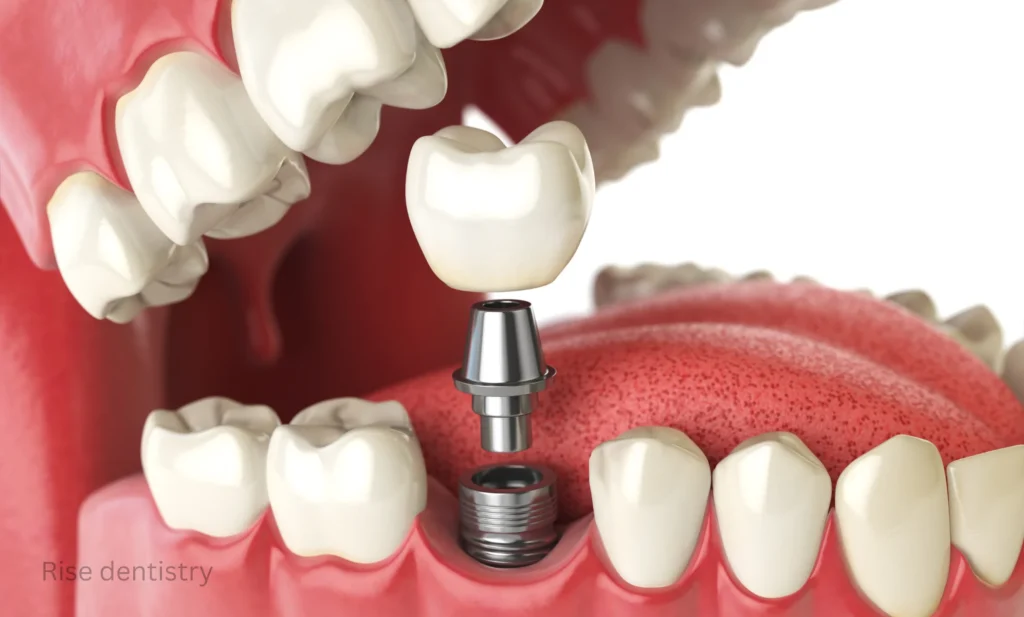 dental implants