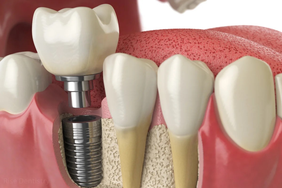 dental implants for dentures