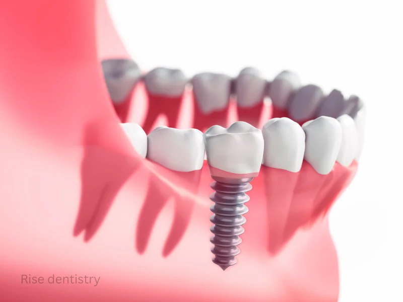 dental implants with removable dentures