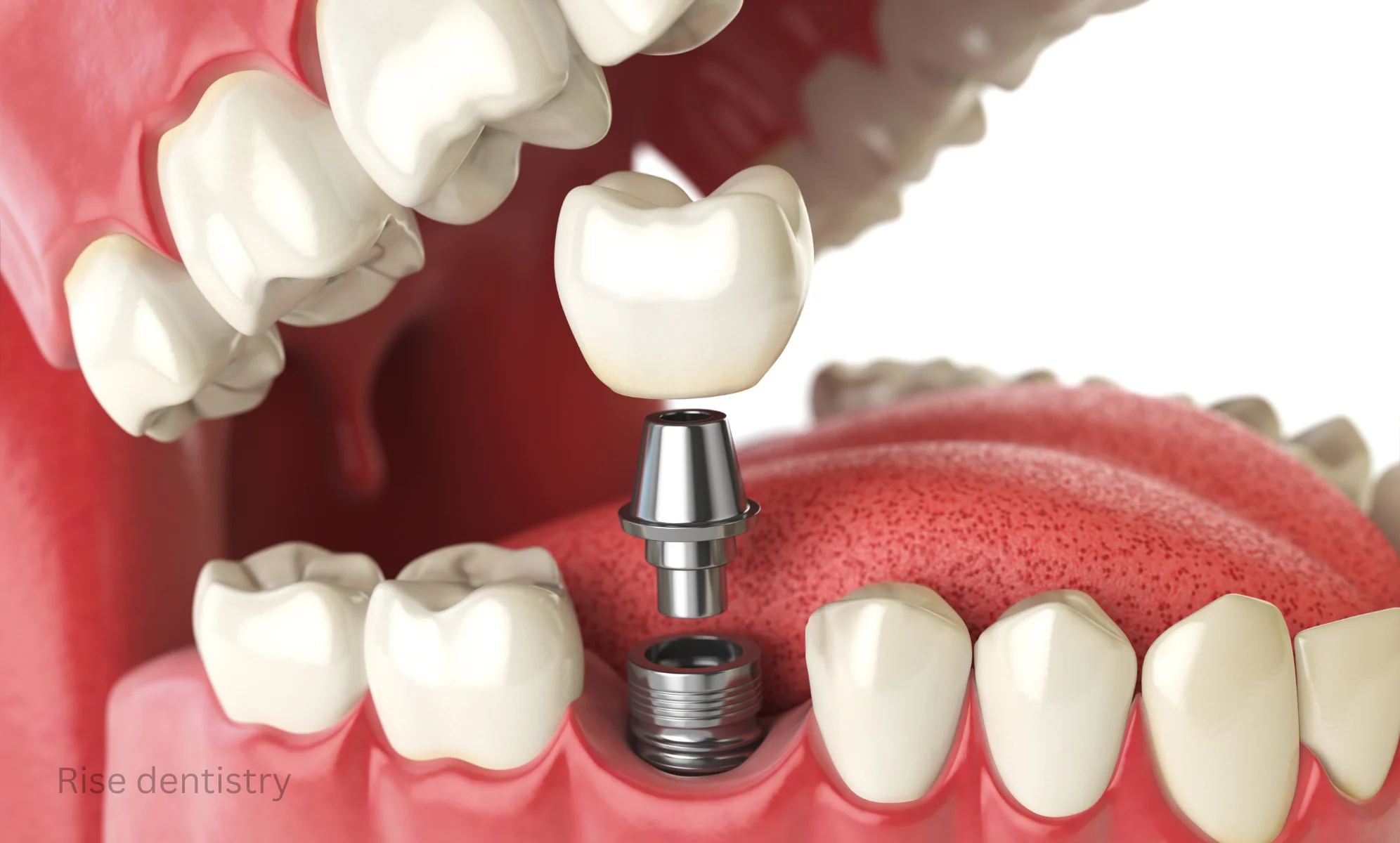 dental implants