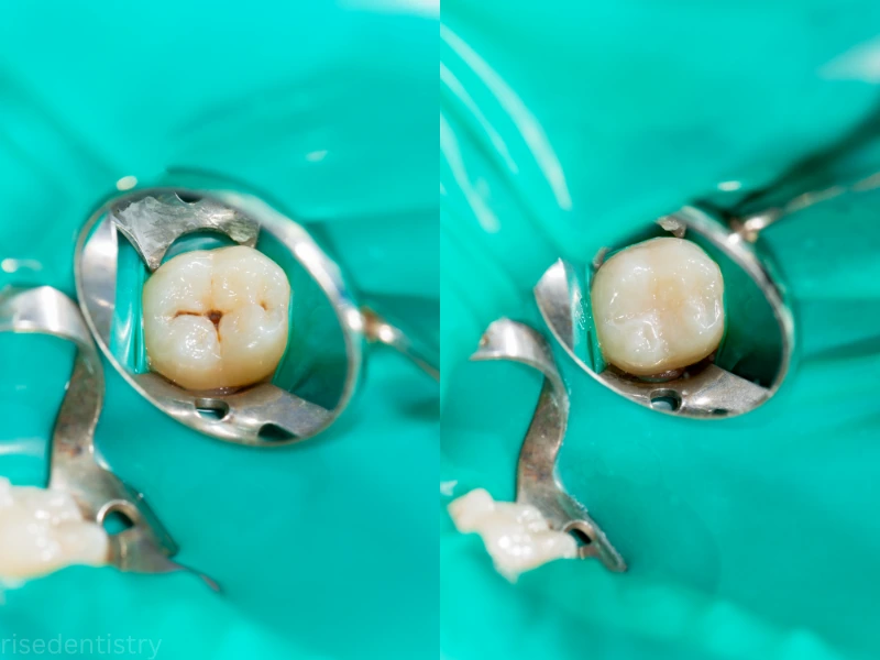 dental sealant service in magnolia tx