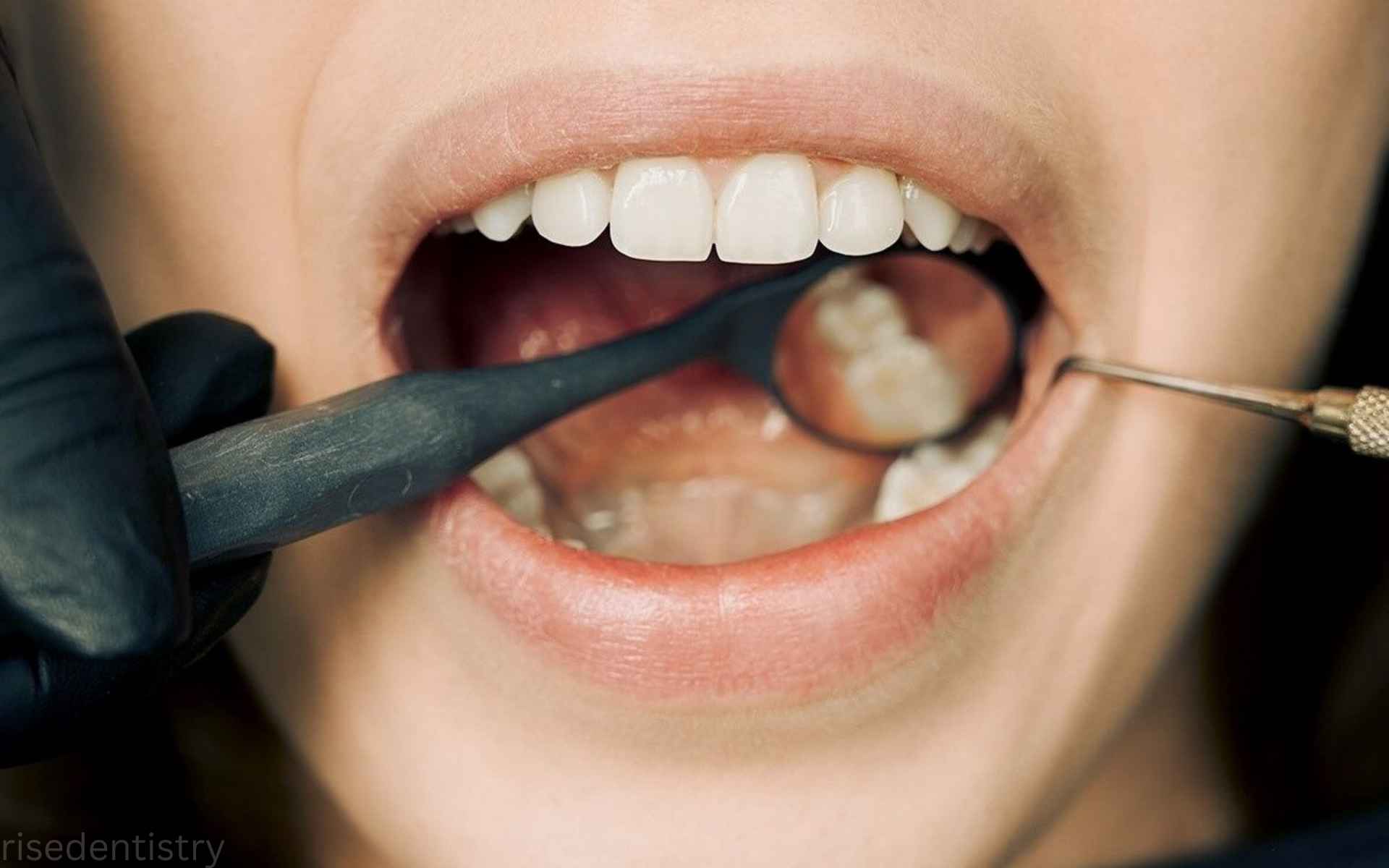 dental sealants in magnolia tx
