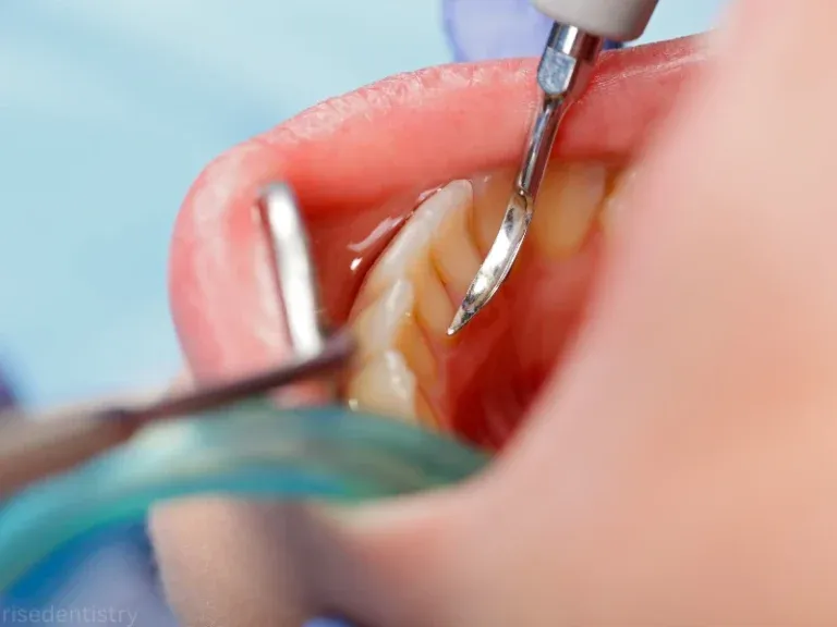 dentist may determine a deep cleaning is necessary
