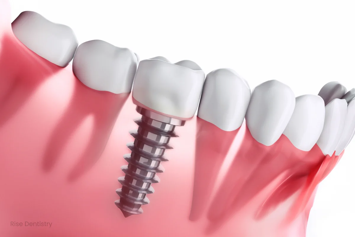 fixed implant dentures