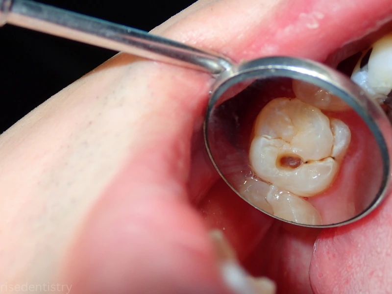 good candidates for dental sealants