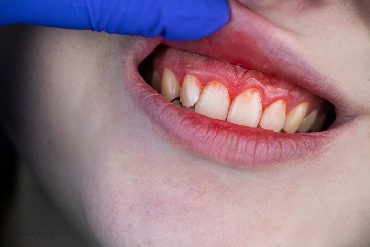 gums bleeding after dental cleaning