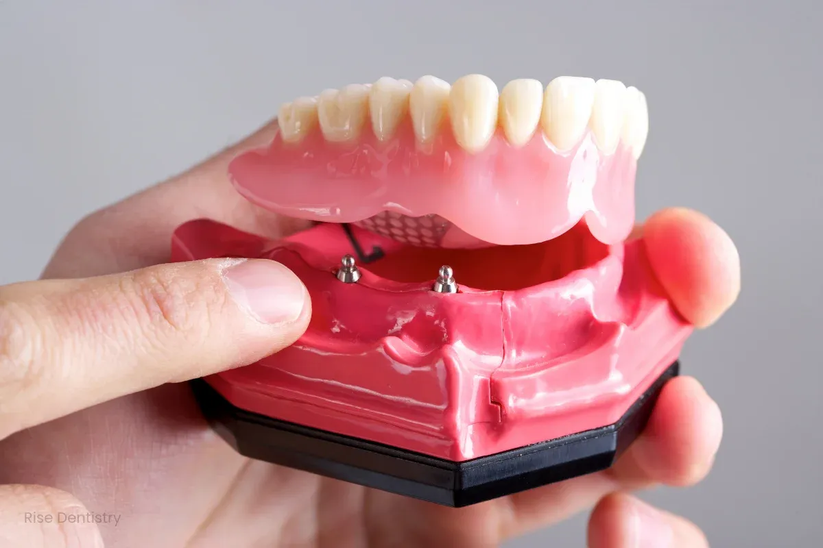 how do denture implant work