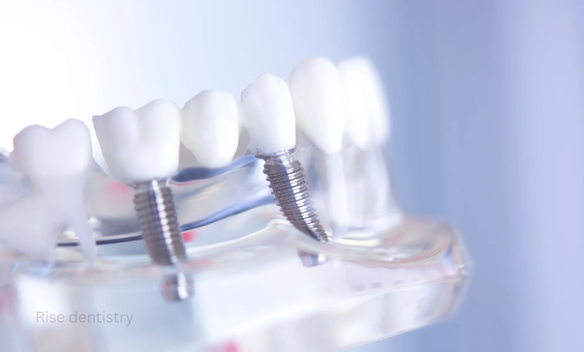 how long do denture implants last