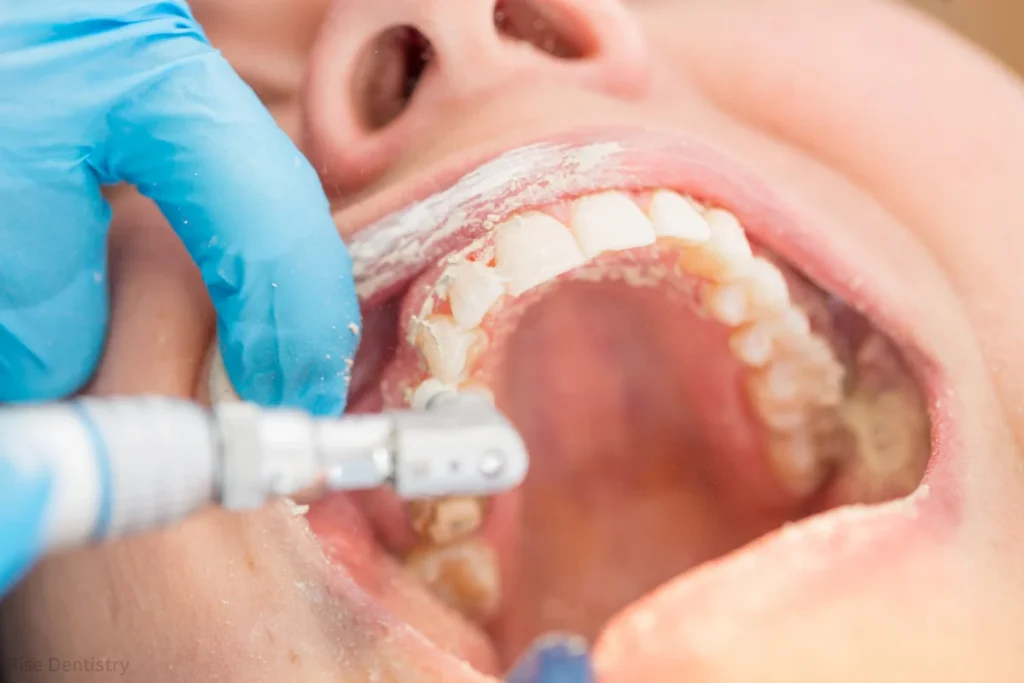 how long does a dental cleaning last