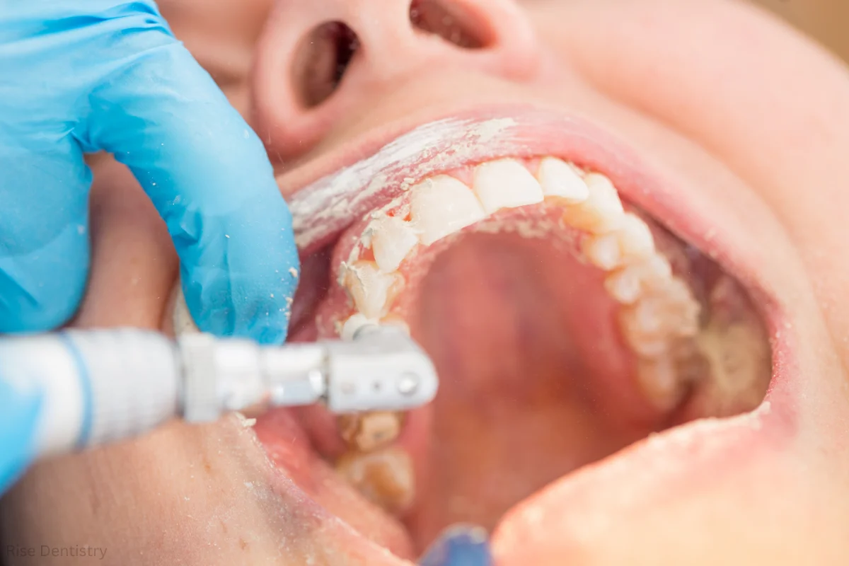 how long does a dental cleaning last