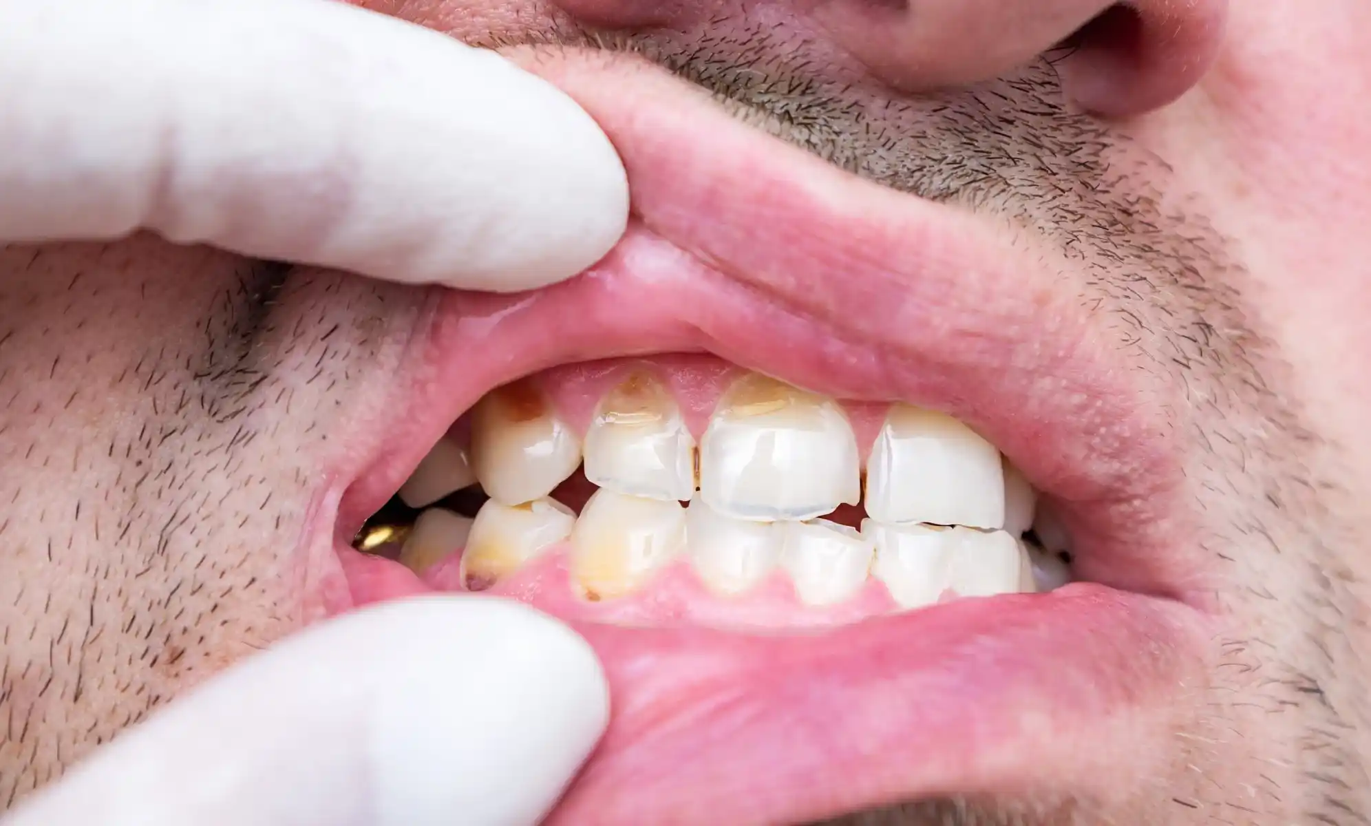 how much does it cost to fix a chipped tooth​
