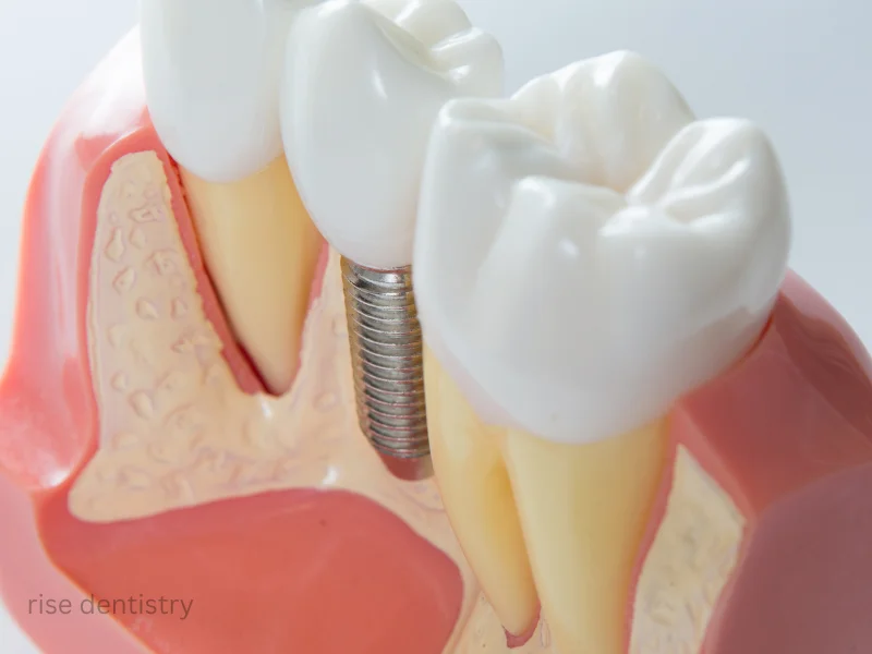 implant-supported dentures
