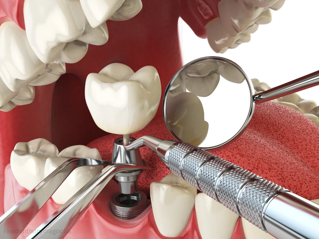 permanent dentures with implants