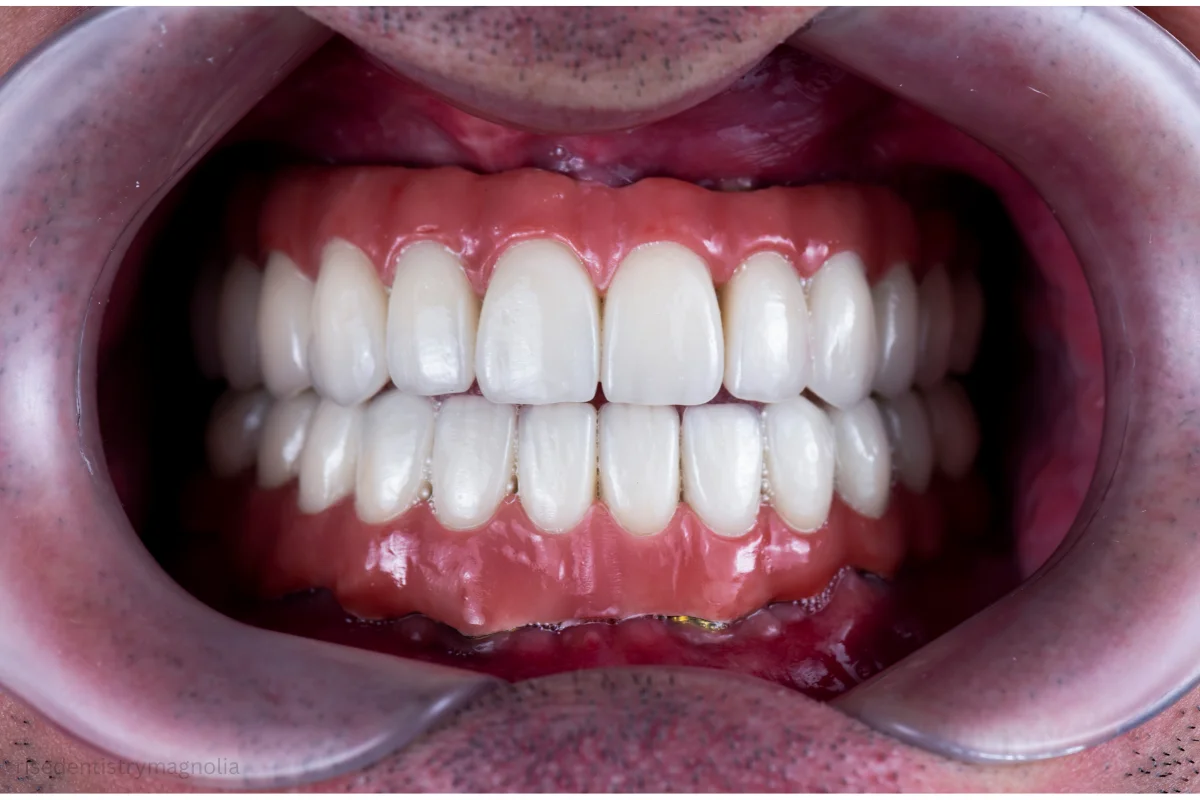 removable dentures