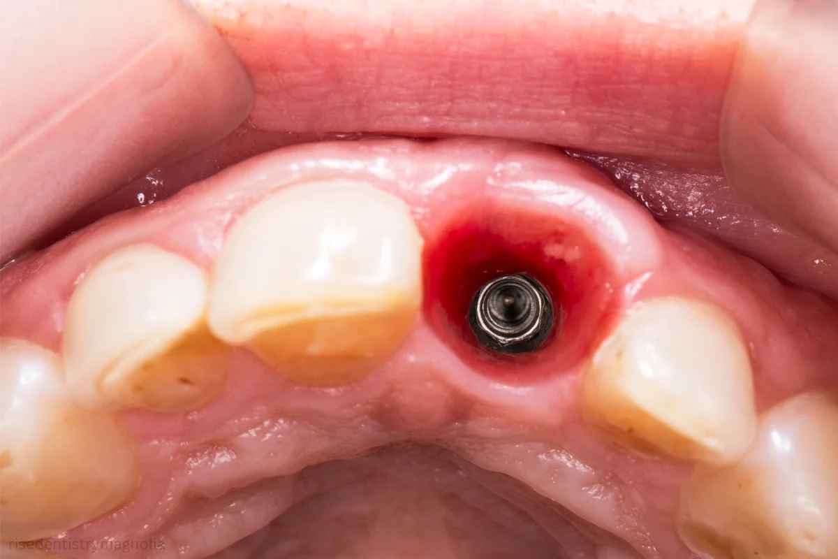 replacement dentures