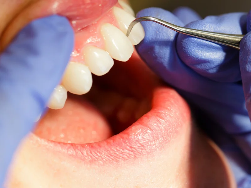 routine dental cleanings