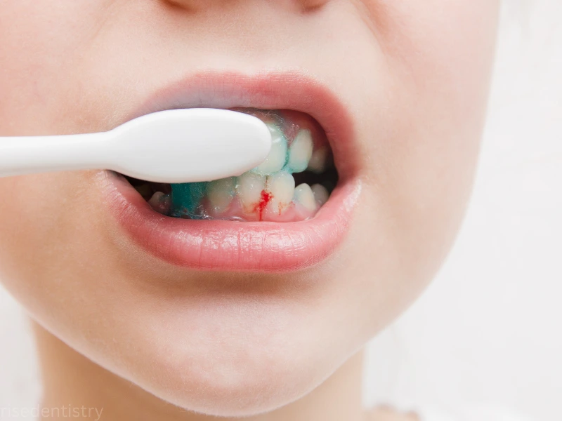 swollen bleeding gums treatment