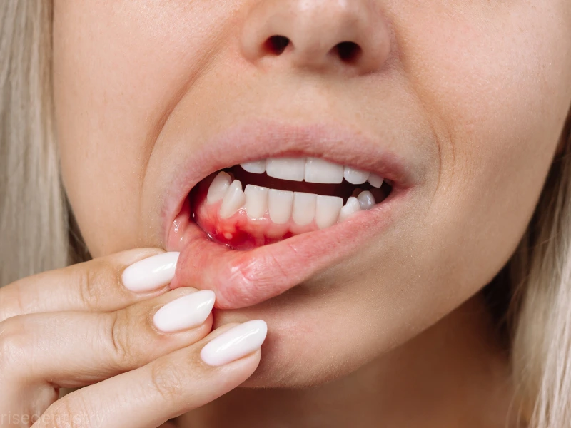 tooth abscess treatment before and after