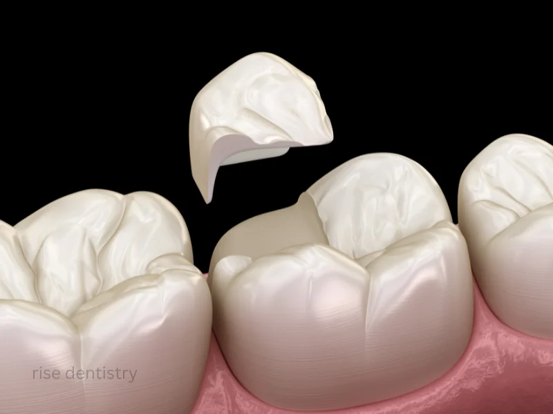 tooth crown benefits