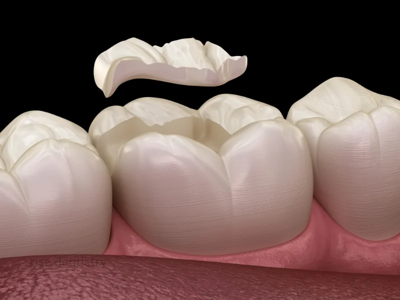 tooth crown in magnolia tx