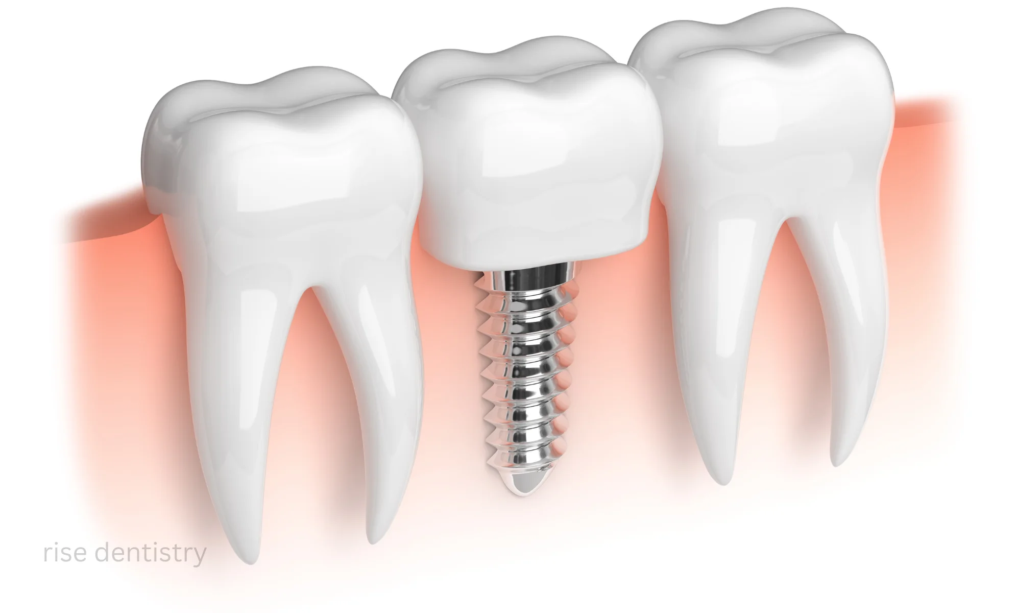 types of denture implants