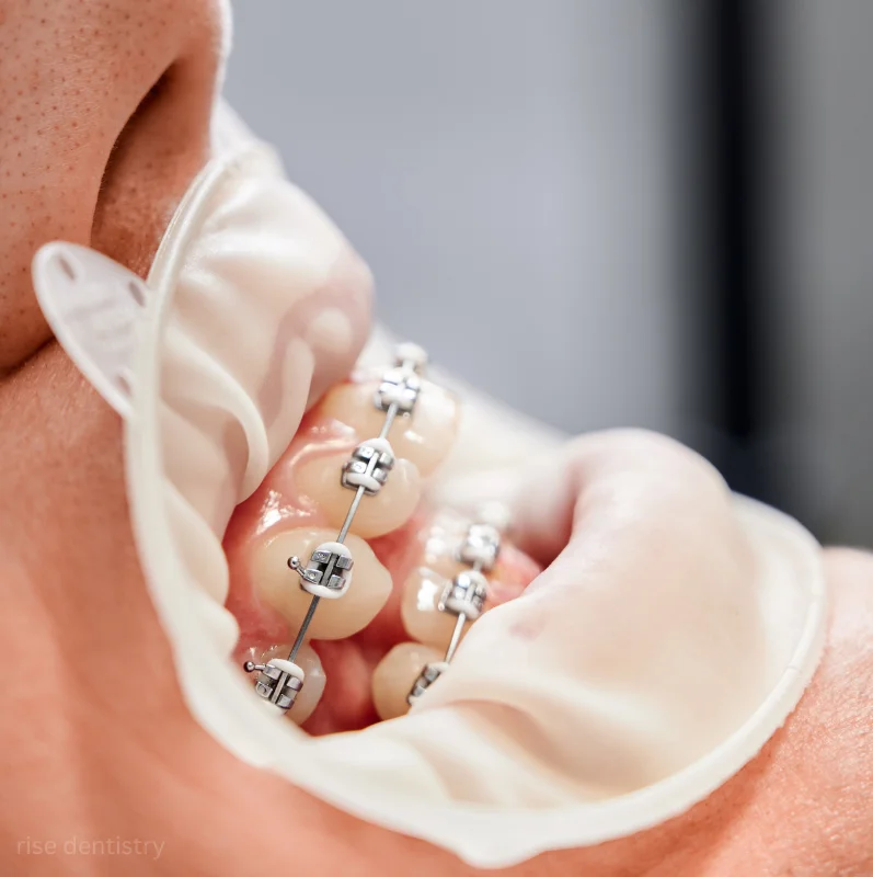 understanding clear aligners and their benefits