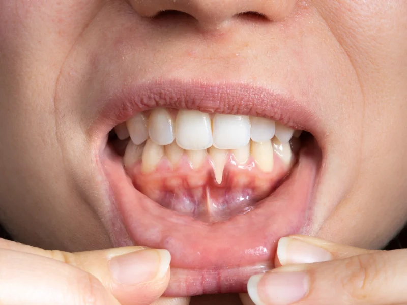 what is bleeding gums