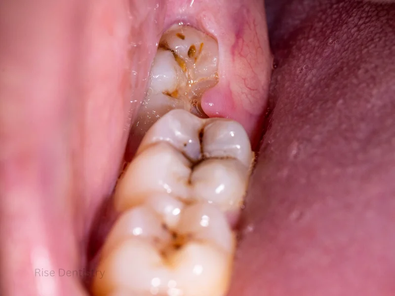 wisdom teeth removal in magnolia tx